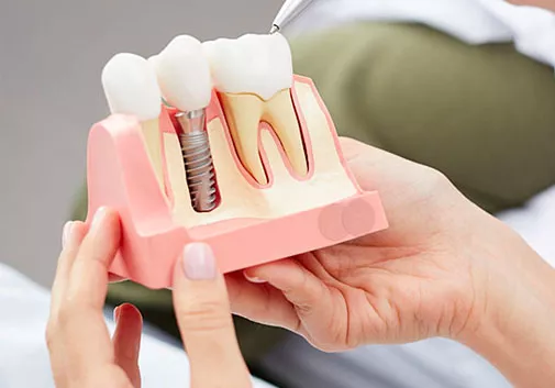 Model of dental implant